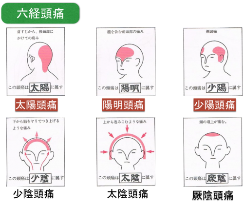 西洋医学では3分类に分けられる头痛ですが,   太阳头痛は,主に后
